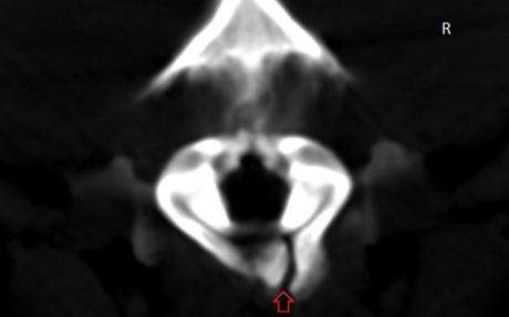 Клинический случай №1. Компьютерная томография, аксиальное изображение. Стрелкой указан участок расщепления вентральной дужки атланта.