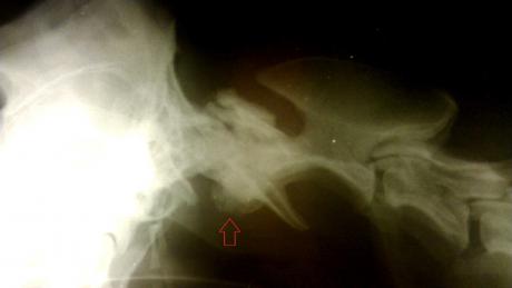 Клинический случай №2. Рентгенография. Стрелкой указано патологическое утолщение вентральной дужки атланта.